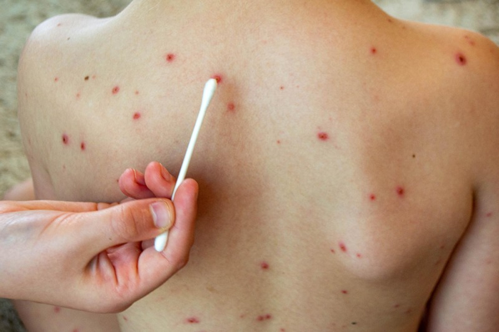 chickenpox scar removal