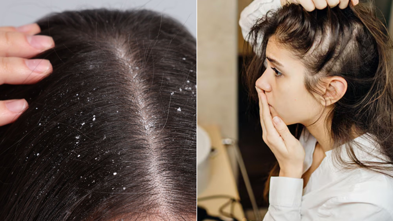 Is Winter Dandruff Getting Worse? Know the Causes and Effective Solutions