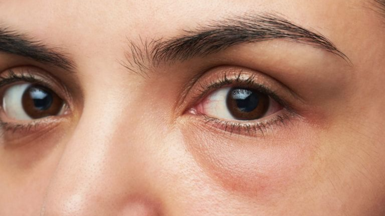 Red and Puffy Eyes? This Could Be a Warning Sign from Your Kidneys