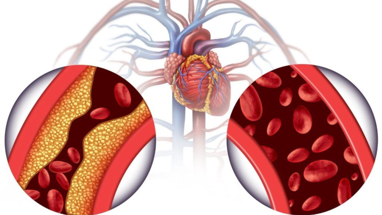 What Causes Heart Diseases? Do You Know the Types of Cholesterol?