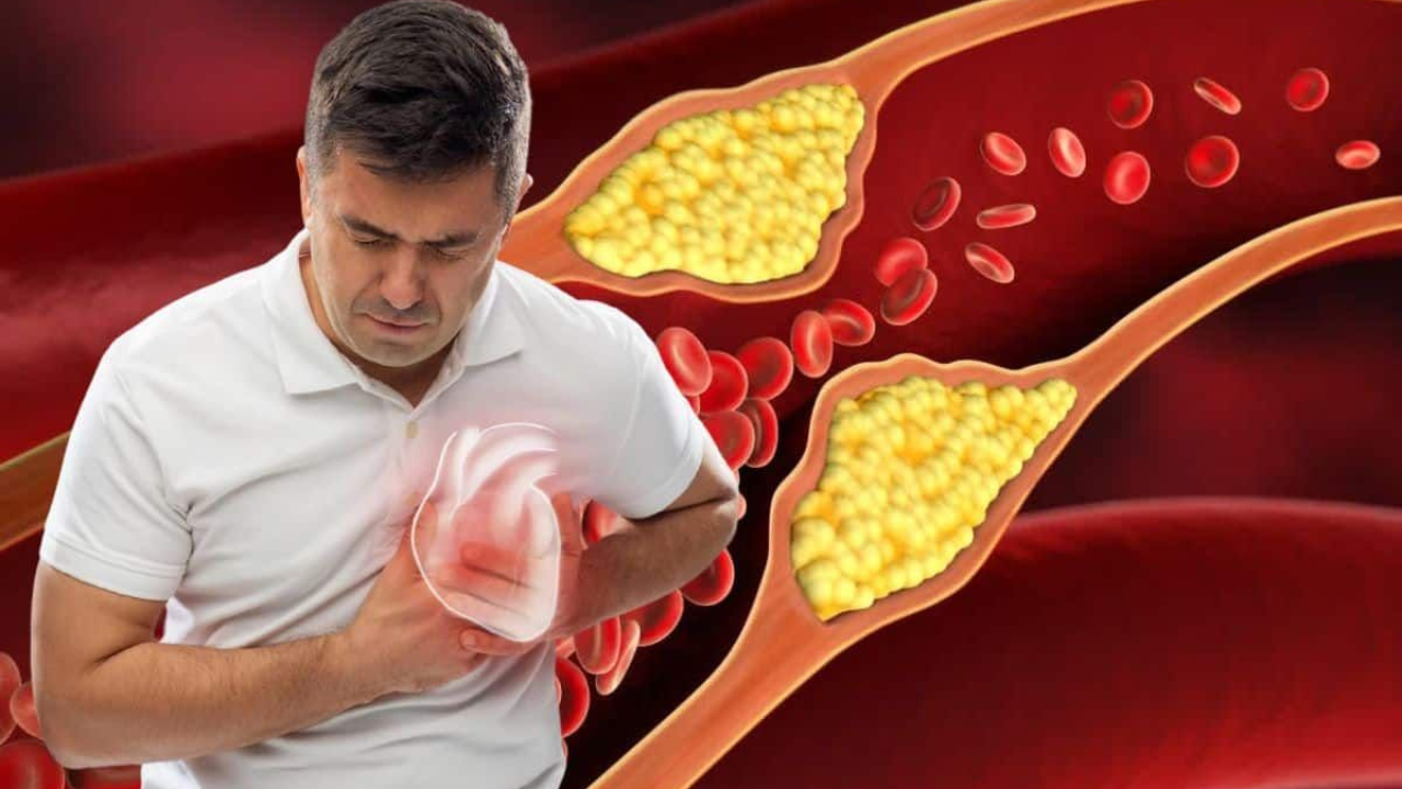 What Causes Heart Diseases? Do You Know the Types of Cholesterol?