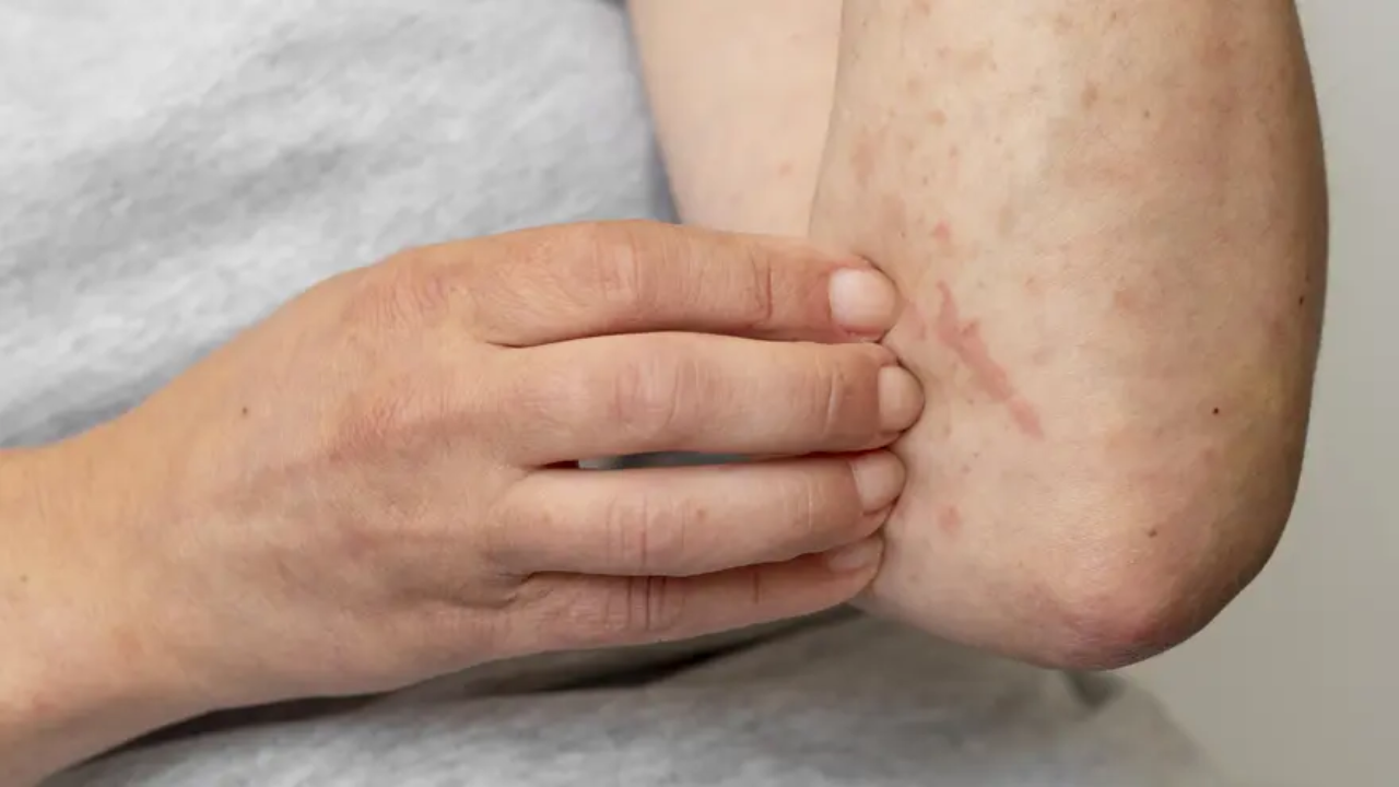 “Afraid of Sunlight? Interesting Facts About Porphyria Disease” |