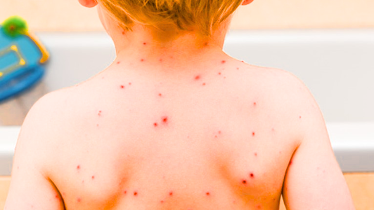 Important Precautions to Follow During Chickenpox
