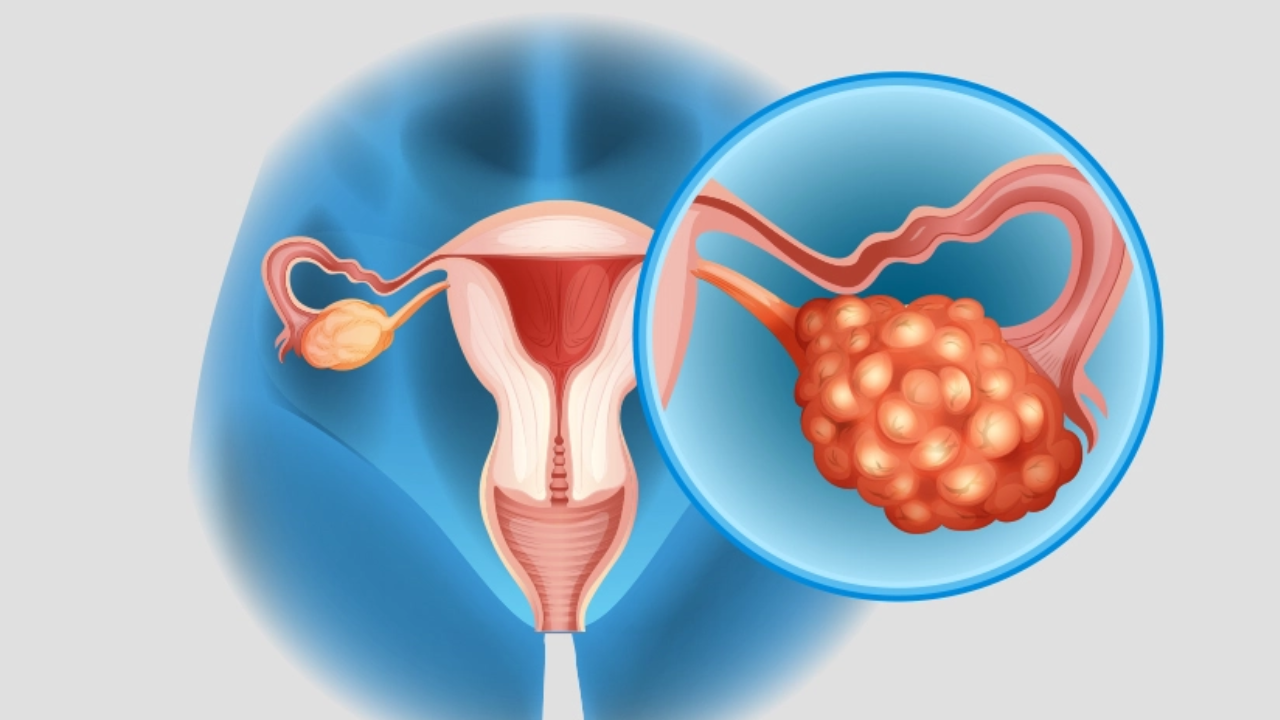 Early Symptoms of PCOD in Teens Every Parent Should Know