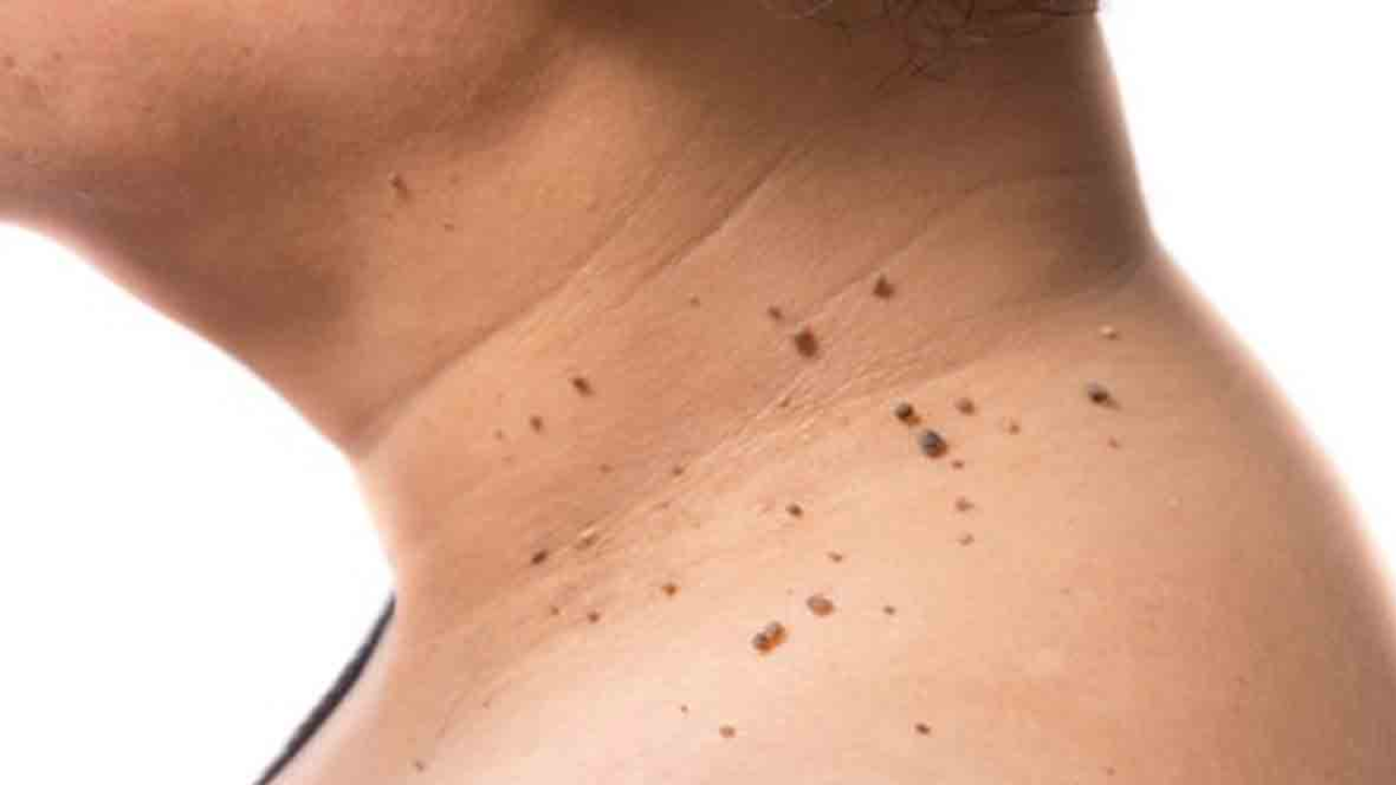 Noticing Skin Warts? Don't Ignore Them – Essential Care Tips