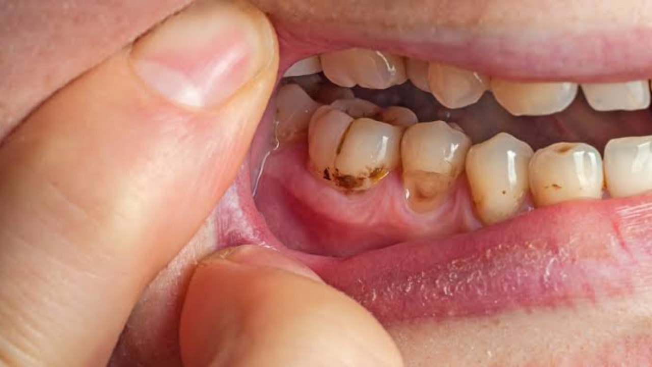 Tooth Decay Alert: The Common Habit That May Be Damaging Your Teeth