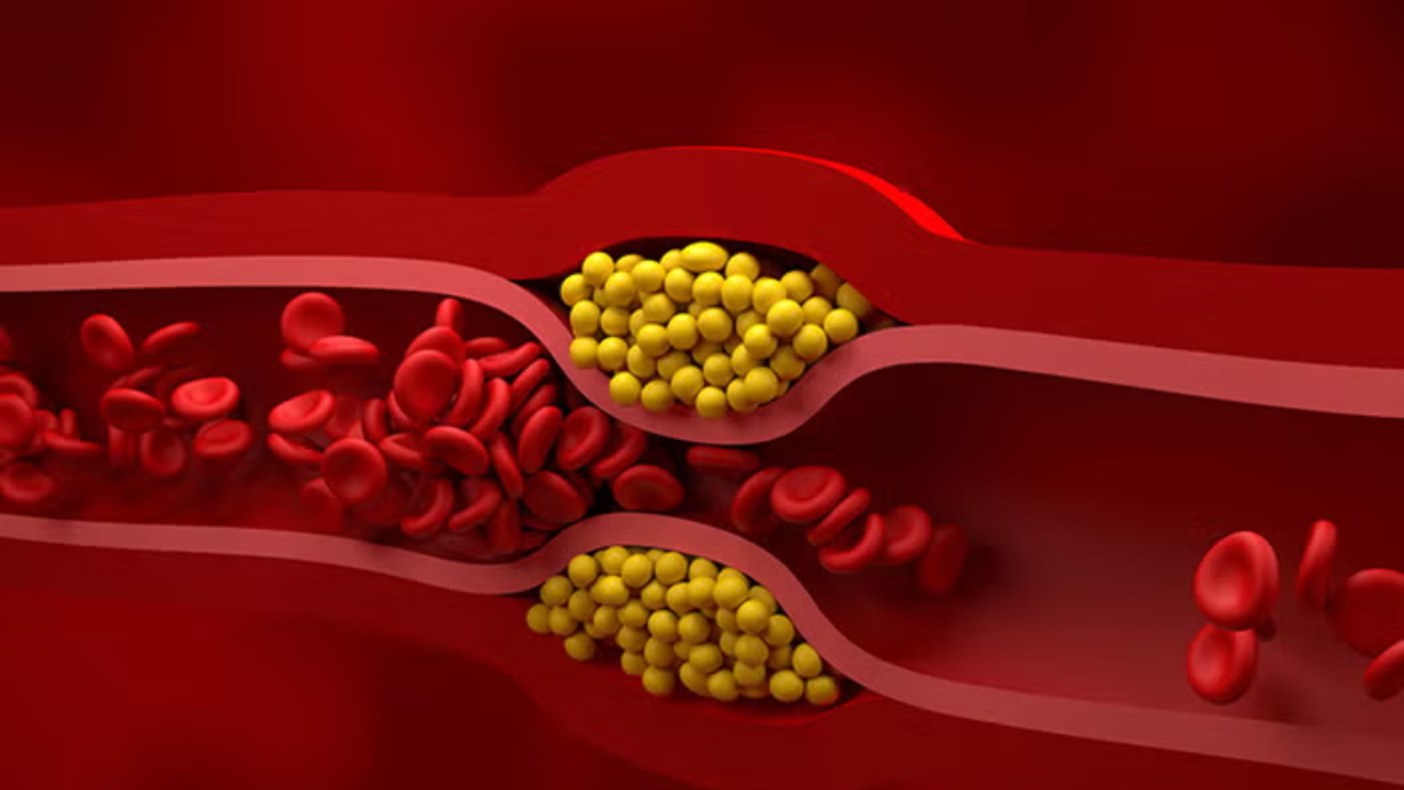 High LDL Cholesterol? Watch for These 3 Body Warning Signals
