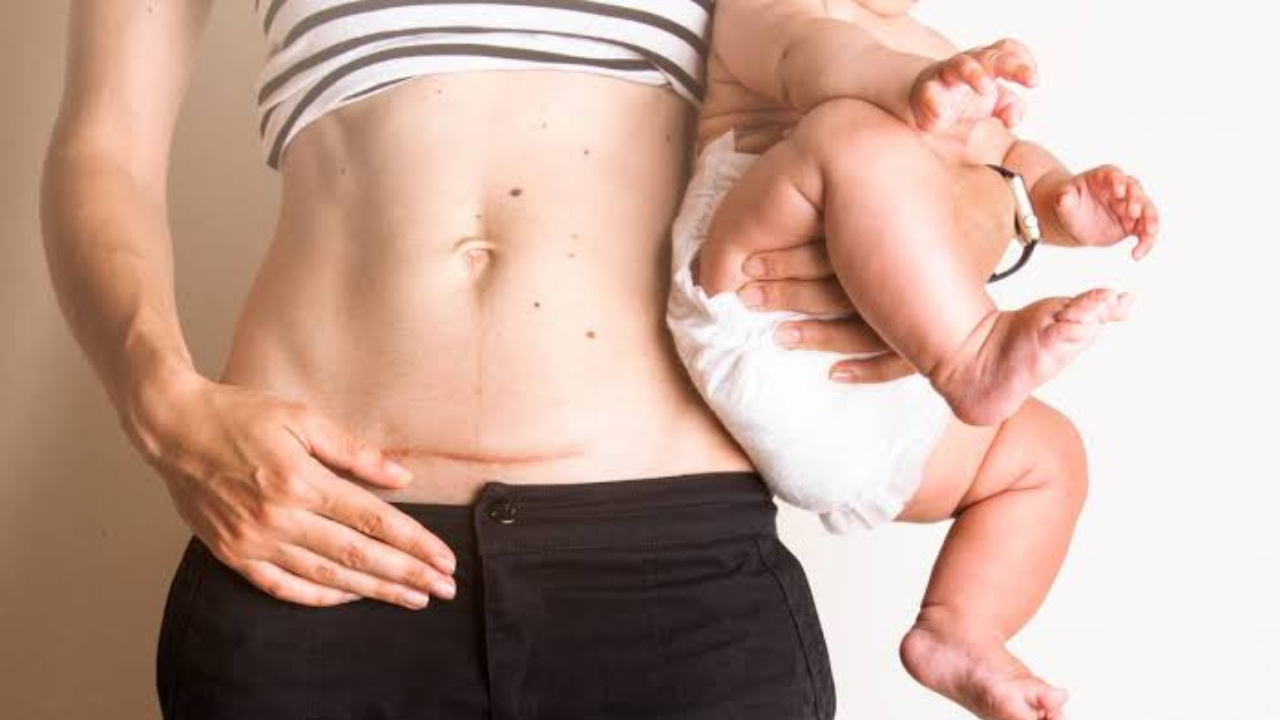 Planning a Second Baby After C-Section? Know the Right Time and Essential Precautions