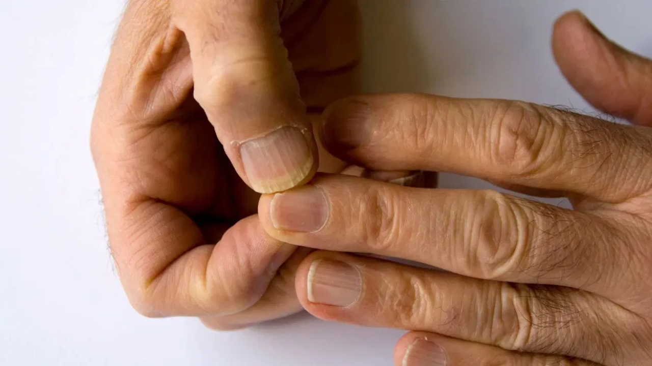 Nail Fungus? Try These Simple Tips to Relieve Pain and Itching